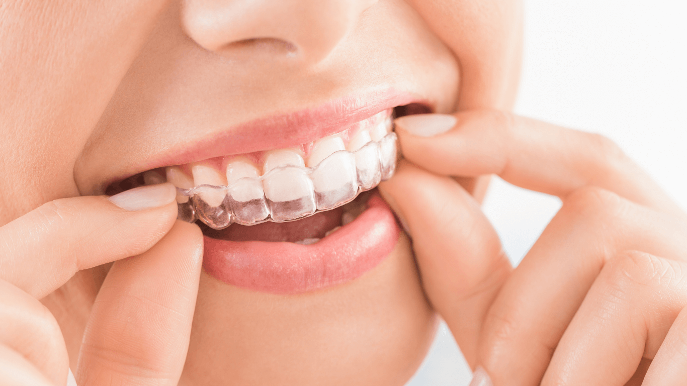Clear Aligners in Stafford, VA Discreet Orthodontic Treatment
