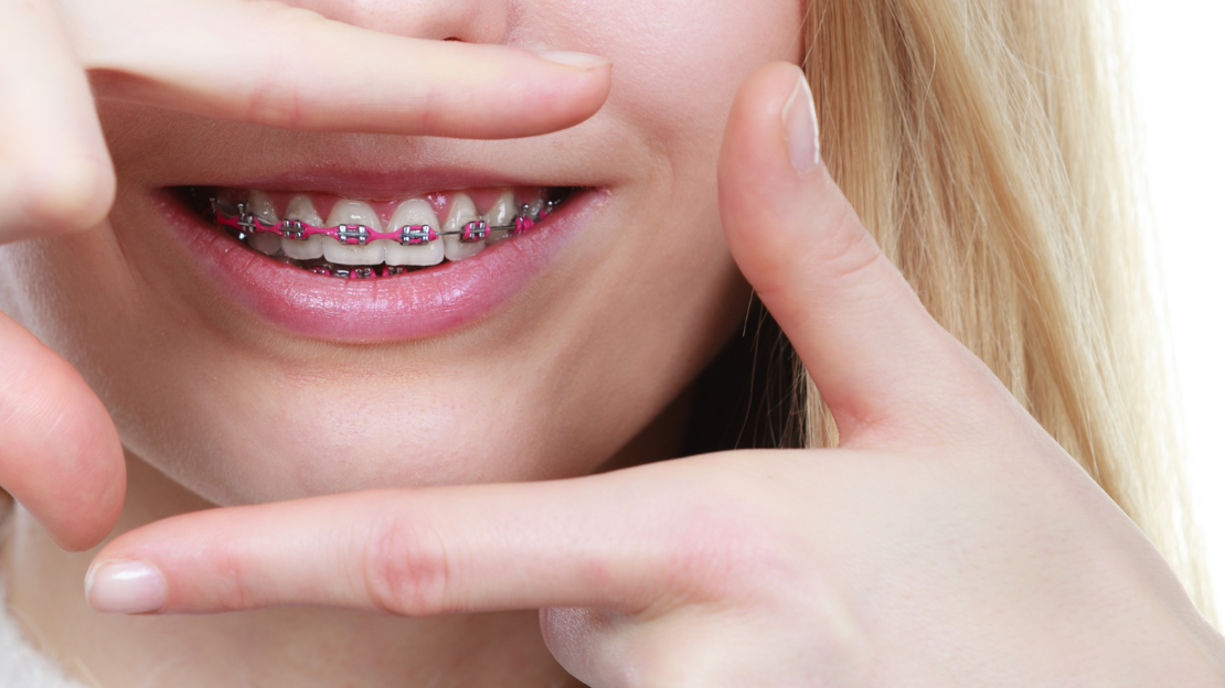 Braces