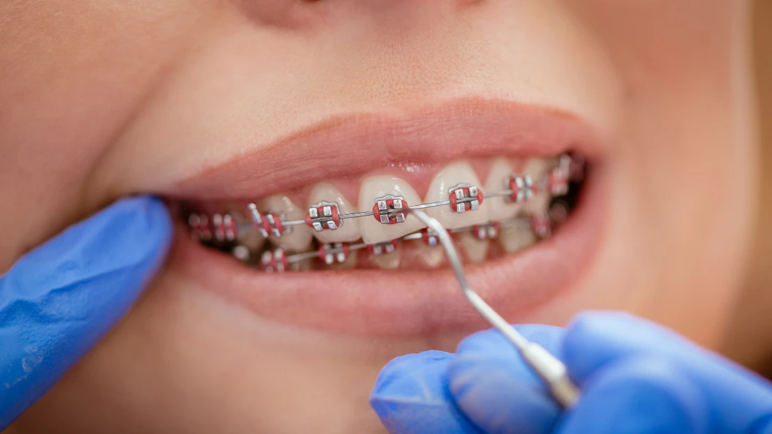 Traditional Metal Braces