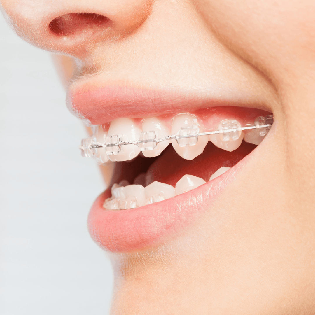 Ceramic Braces